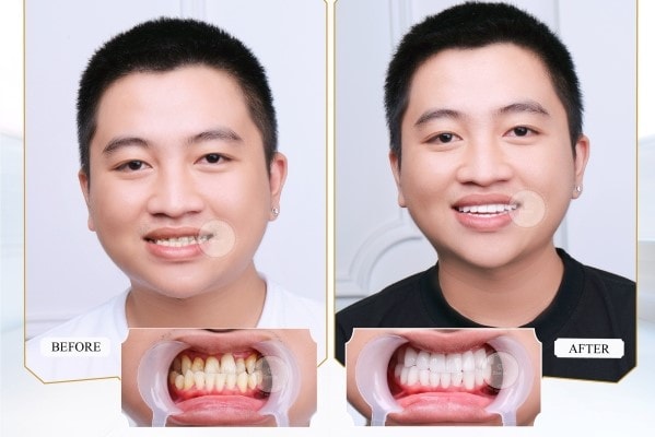 Làm răng sứ đem lại rất nhiều lợi ích